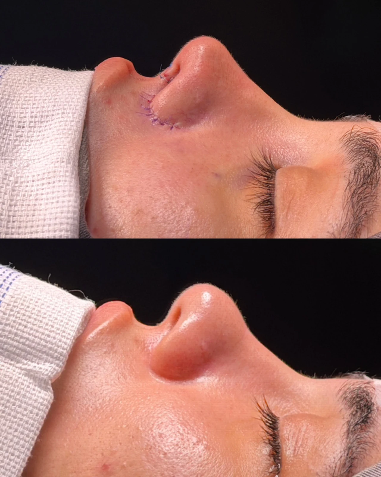 Caso de rinoplastia — montagem 3