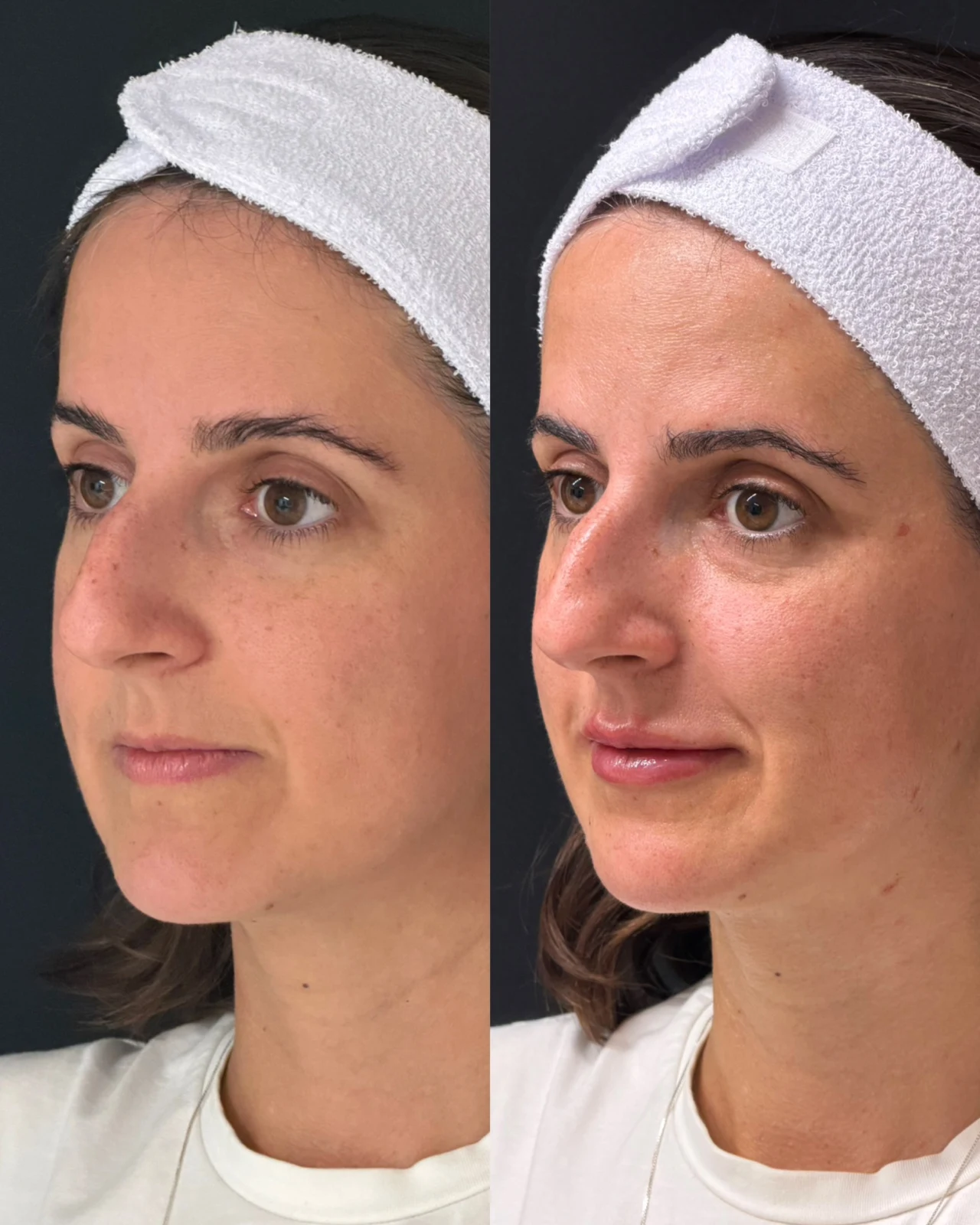 Caso de rinoplastia — montagem 1