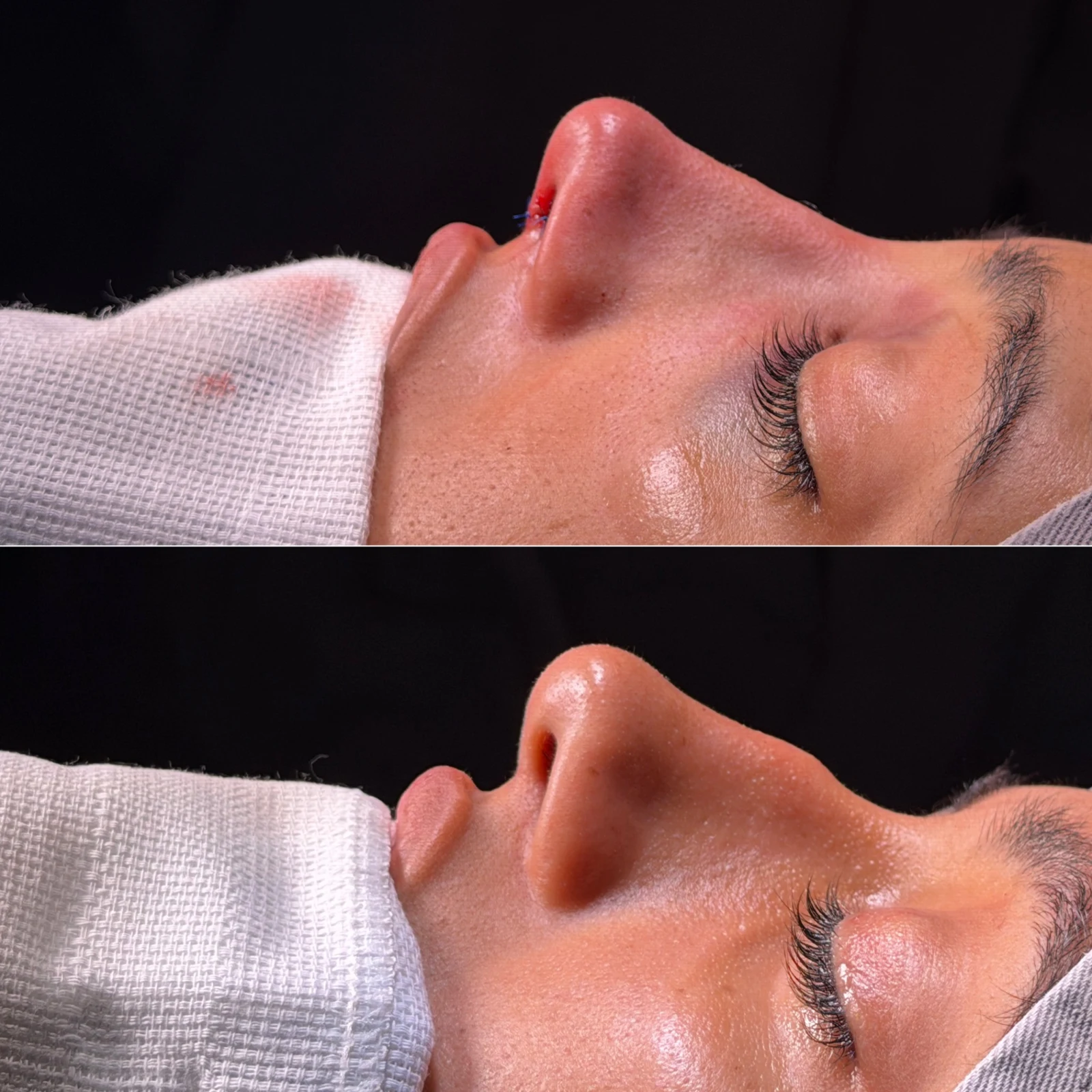 Caso de rinoplastia — montagem 8