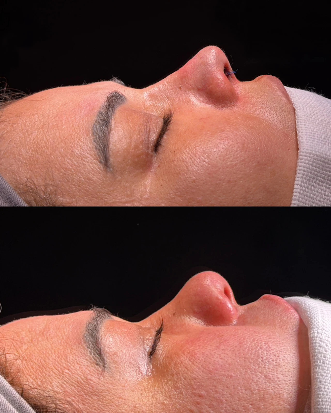 Caso de rinoplastia — montagem 4