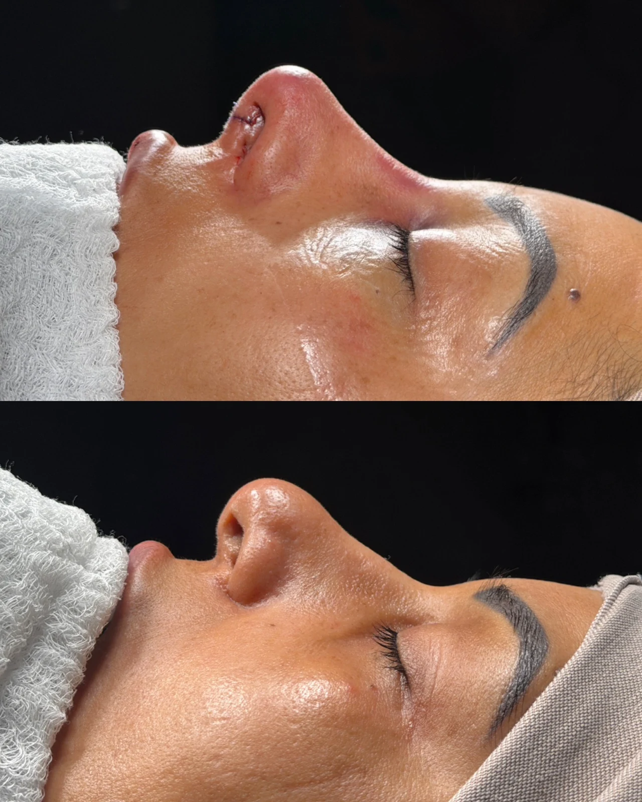 Caso de rinoplastia — montagem 7