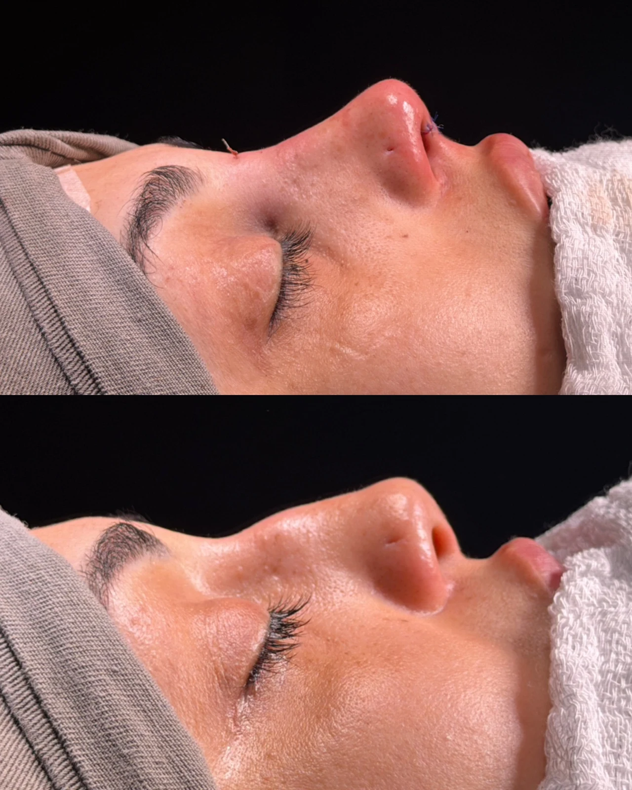 Caso de rinoplastia — montagem 5