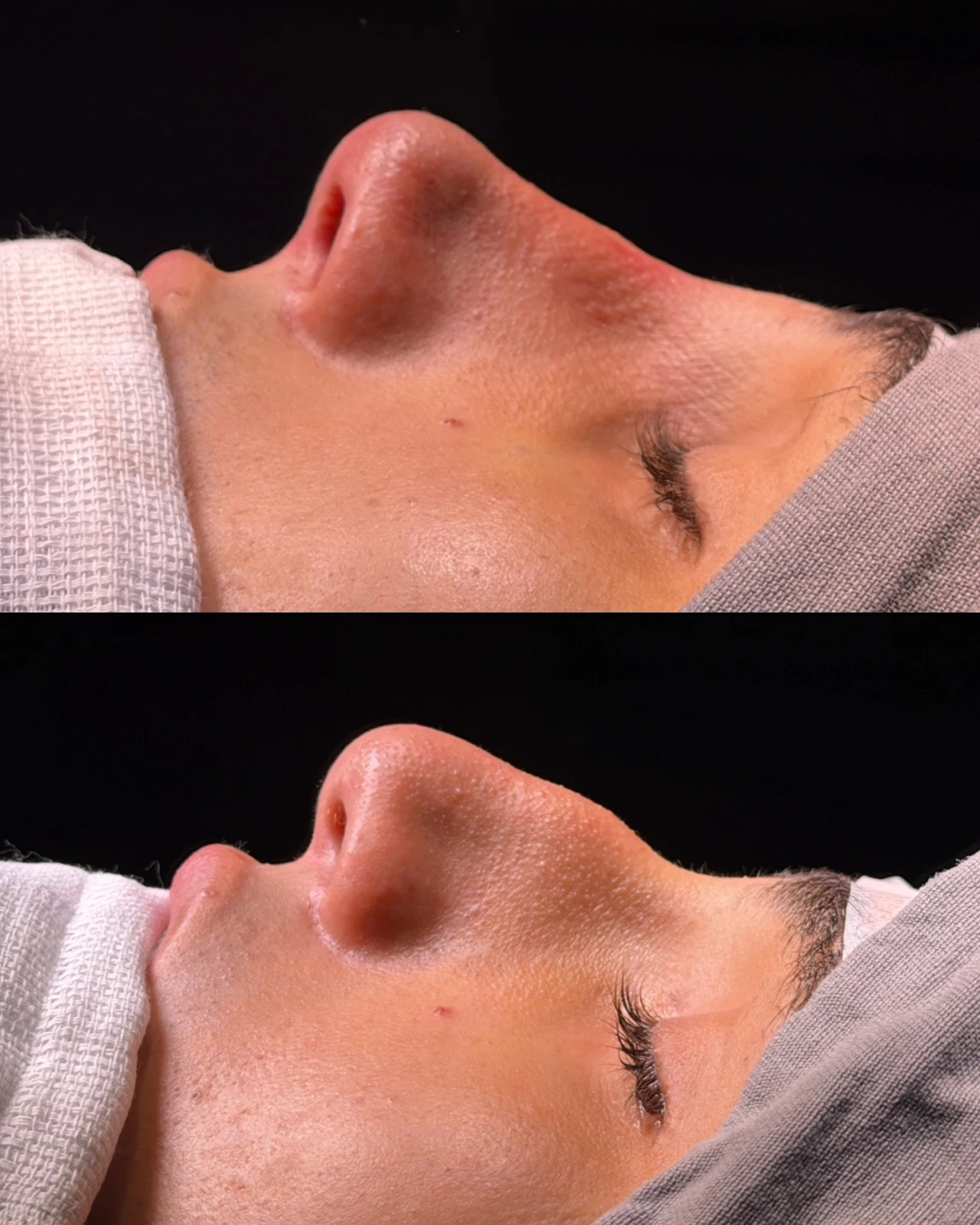 Caso de rinoplastia — montagem 2