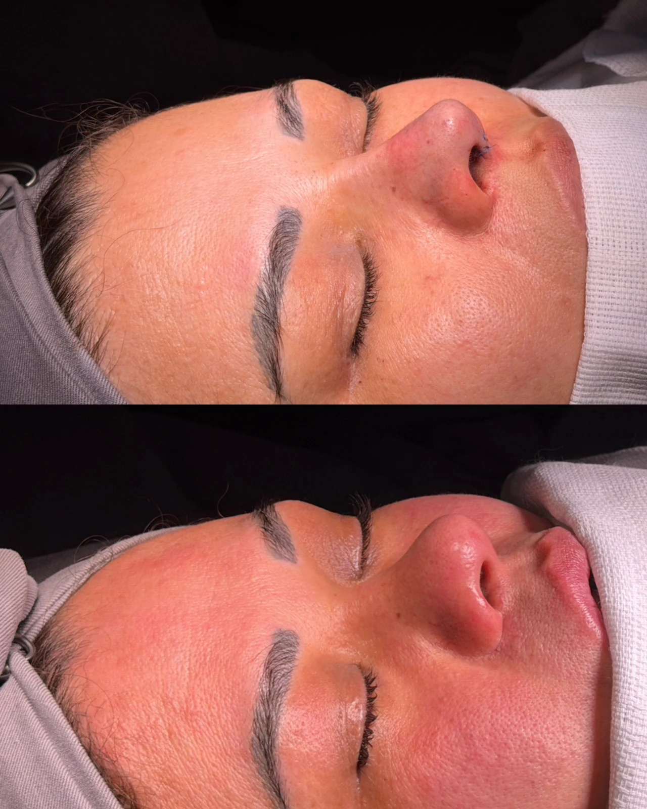 Caso de rinoplastia — montagem 6